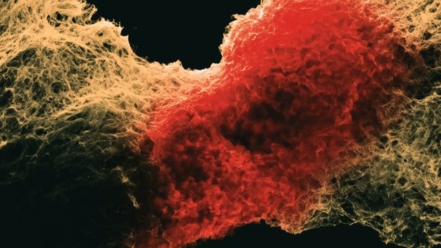 How GitLab's Founder Used AI to Fight His Cancer